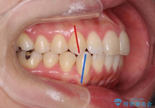マイクロインプラントで達成する出っ歯の後方移動の症例 治療後