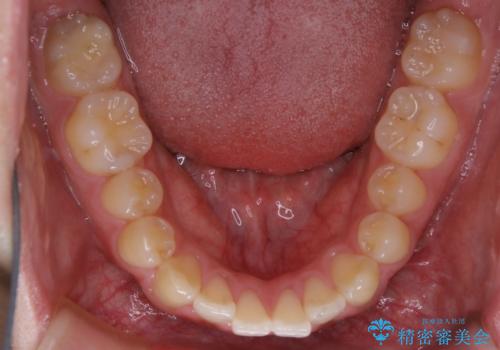 インビザライン矯正 過去に矯正治療したが、また前歯にがたつきがでてきて治したいの治療前