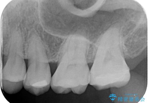 【セラミックインレー】銀の詰め物を白くしたいの治療後