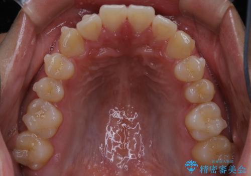 インビザライン矯正 過去に矯正治療したが、また前歯にがたつきがでてきて治したいの治療中