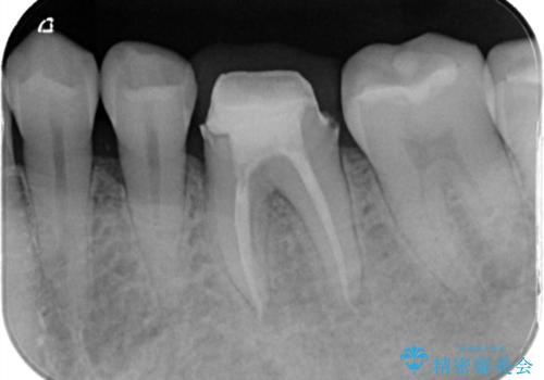 【根管治療】物が当たるだけで痛いの症例 治療後