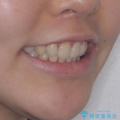 指が入るくらいに隙間のある上下前歯 抜歯矯正で横顔の印象が大きく改善の治療後(顔貌)