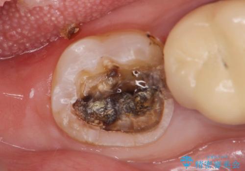 割れたセラミック下に再発した虫歯の治療中