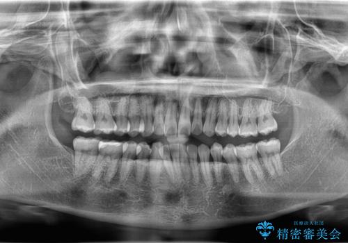 【インビザライン、10ヵ月で矯正終了!】下の前歯が斜めになっているのを治したい!の治療前