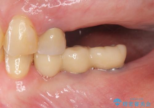 奥歯がない　咬合力を回復するインプラント治療の治療前