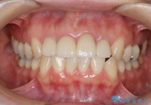 黒っぽい歯ぐきを改善したい　メタルフリーセラミック治療の治療後