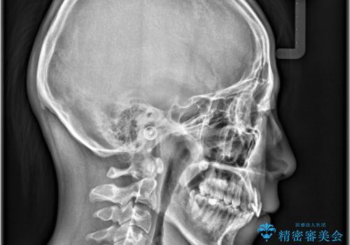 【ワイヤー矯正 11ヵ月で矯正終了!】歯のでこぼこを治したい! の治療後