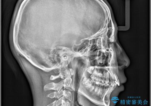 【ワイヤー矯正 11ヵ月で矯正終了!】歯のでこぼこを治したい! の治療前