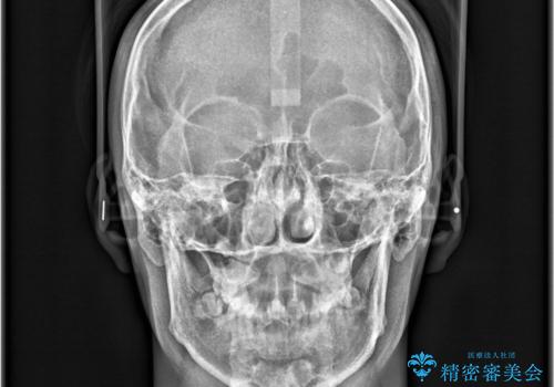 【ワイヤー矯正 11ヵ月で矯正終了!】歯のでこぼこを治したい! の治療前