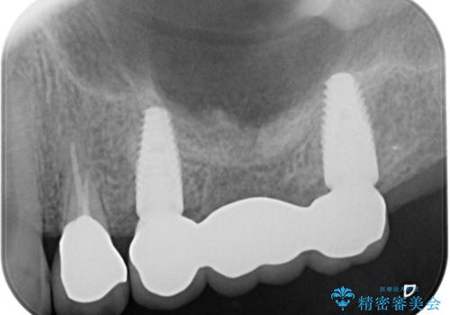 奥歯がない　咬合力を回復するインプラント治療の治療後