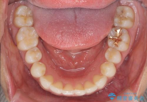 [ インビザライン ]  目立たないマウスピース矯正で、前歯のがたつきをきれいにしたいの治療後