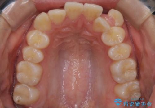 【クリア装置】八重歯の矯正治療の治療前