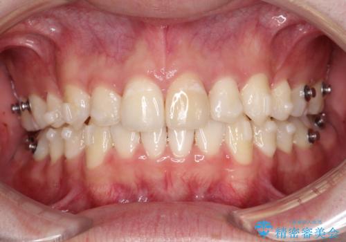 【インビザライン】抜歯矯正で前歯を下げたい。の治療中