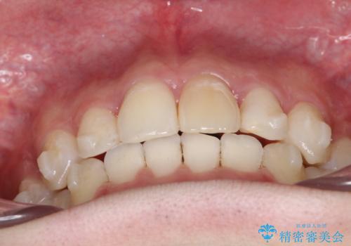 【インビザライン】抜歯矯正で前歯を下げたい。の治療中