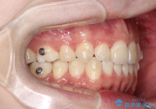 【インビザライン】抜歯矯正で前歯を下げたい。の治療中