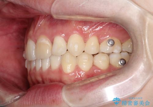 【インビザライン】抜歯矯正で前歯を下げたい。の治療中