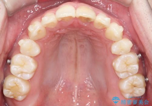【インビザライン】抜歯矯正で前歯を下げたい。の治療中