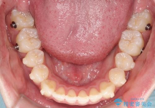 【インビザライン】抜歯矯正で前歯を下げたい。の治療中