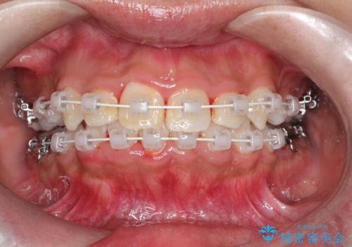 【審美ワイヤー】重度の叢生を治療の治療中