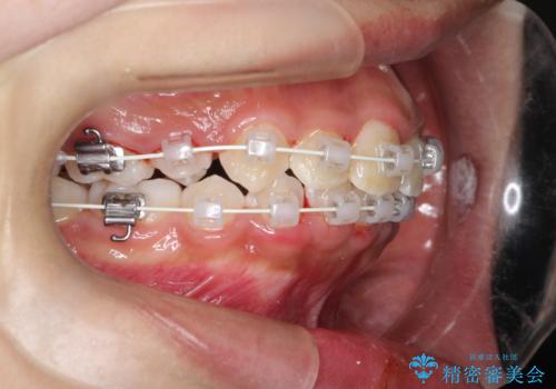【審美ワイヤー】重度の叢生を治療の治療中