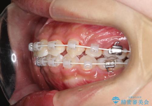 【審美ワイヤー】重度の叢生を治療の治療中