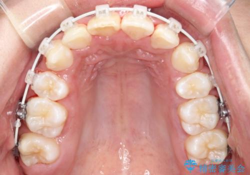 【審美ワイヤー】重度の叢生を治療の治療中