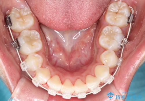 【審美ワイヤー】重度の叢生を治療の治療中
