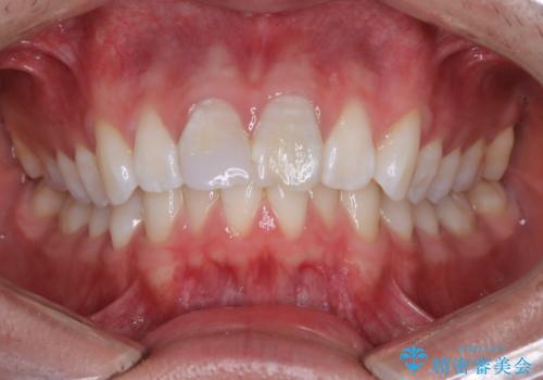 【ワイヤー矯正 11ヵ月で矯正終了!】歯のでこぼこを治したい! の治療前