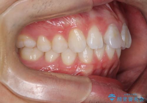 【ワイヤー矯正 11ヵ月で矯正終了!】歯のでこぼこを治したい! の治療前