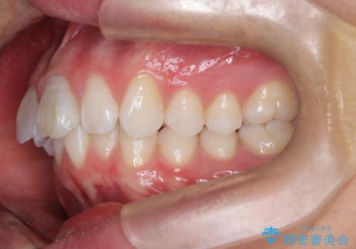 【ワイヤー矯正 11ヵ月で矯正終了!】歯のでこぼこを治したい! の治療前