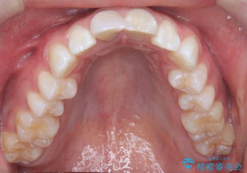 【ワイヤー矯正 11ヵ月で矯正終了!】歯のでこぼこを治したい! の治療前