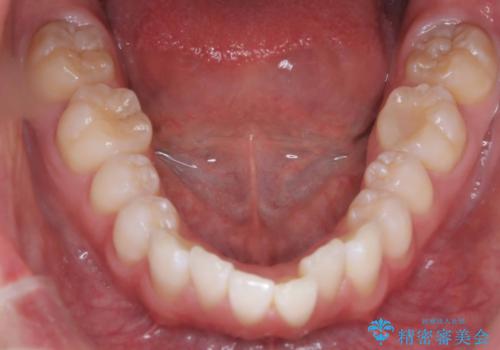 【ワイヤー矯正 11ヵ月で矯正終了!】歯のでこぼこを治したい! の治療前