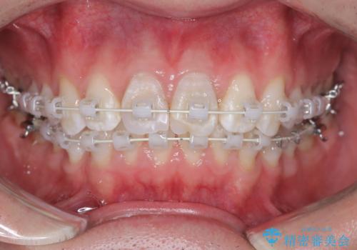 【ワイヤー矯正 11ヵ月で矯正終了!】歯のでこぼこを治したい! の治療中