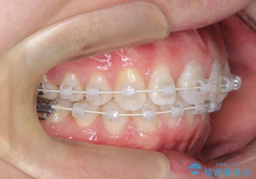 【ワイヤー矯正 11ヵ月で矯正終了!】歯のでこぼこを治したい! の治療中