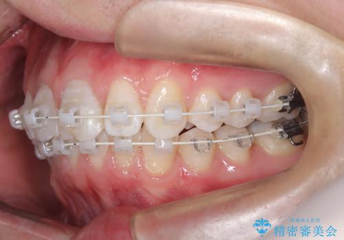 【ワイヤー矯正 11ヵ月で矯正終了!】歯のでこぼこを治したい! の治療中