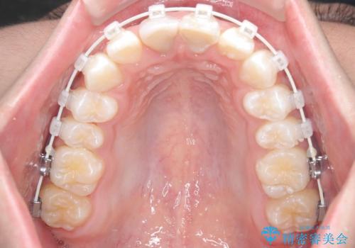 【ワイヤー矯正 11ヵ月で矯正終了!】歯のでこぼこを治したい! の治療中