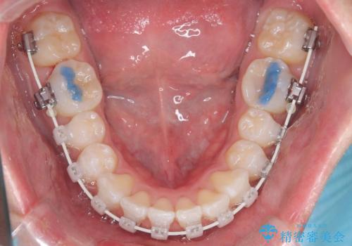 【ワイヤー矯正 11ヵ月で矯正終了!】歯のでこぼこを治したい! の治療中