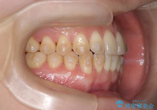 【インビザライン、10ヵ月で矯正終了!】下の前歯が斜めになっているのを治したい!の治療中