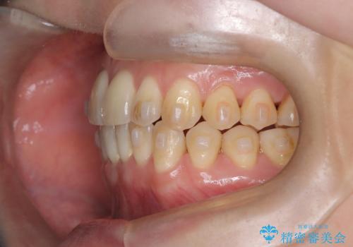 【インビザライン、10ヵ月で矯正終了!】下の前歯が斜めになっているのを治したい!の治療中