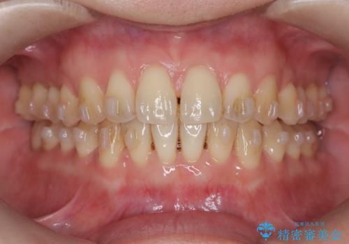 【インビザライン、10ヵ月で矯正終了!】下の前歯が斜めになっているのを治したい!の治療中