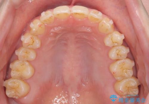 【インビザライン、10ヵ月で矯正終了!】下の前歯が斜めになっているのを治したい!の治療中