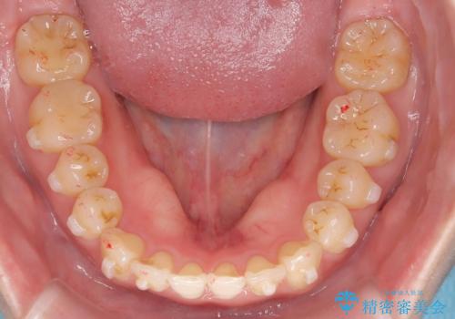 【インビザライン、10ヵ月で矯正終了!】下の前歯が斜めになっているのを治したい!の治療中