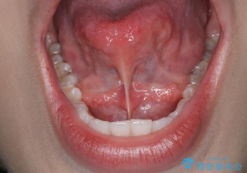 滑舌が気になる、舌小帯形成術の症例 治療前