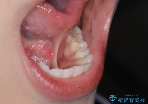 滑舌が気になる、舌小帯形成術