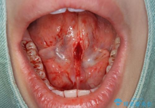 滑舌が気になる、舌小帯形成術の治療中