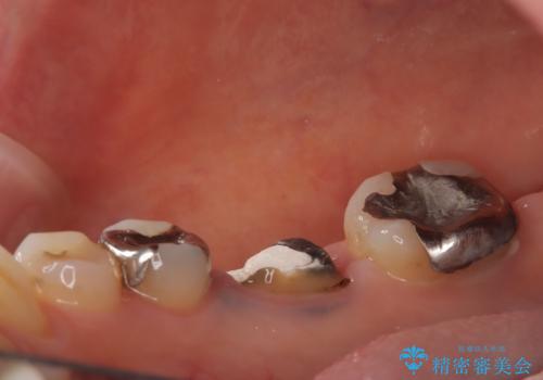 虫歯で失ってしまった奥歯、インプラント治療で再び噛めるように!の治療前