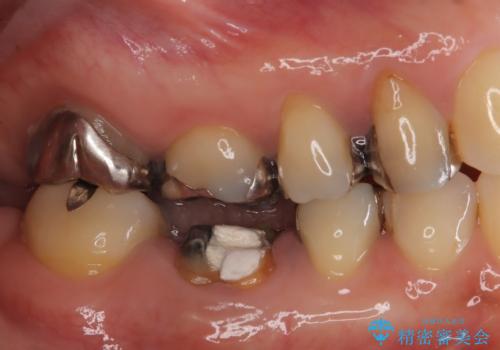 虫歯で失ってしまった奥歯、インプラント治療で再び噛めるように!の治療前