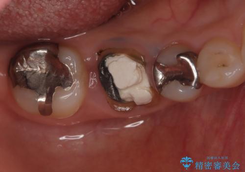 虫歯で失ってしまった奥歯、インプラント治療で再び噛めるように!の治療前