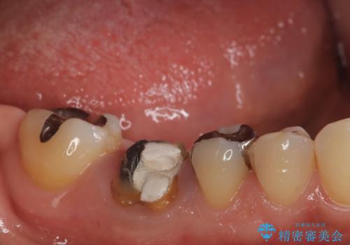 虫歯で失ってしまった奥歯、インプラント治療で再び噛めるように!の治療前