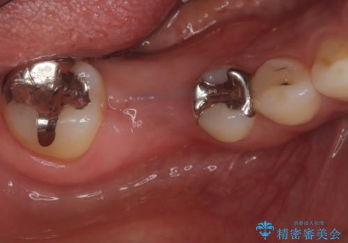 虫歯で失ってしまった奥歯、インプラント治療で再び噛めるように!の治療中